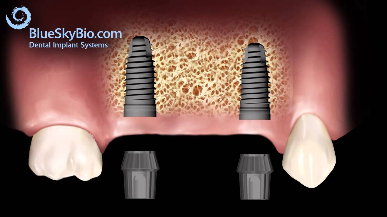 Patient Treatment Videos: Implant Bridge