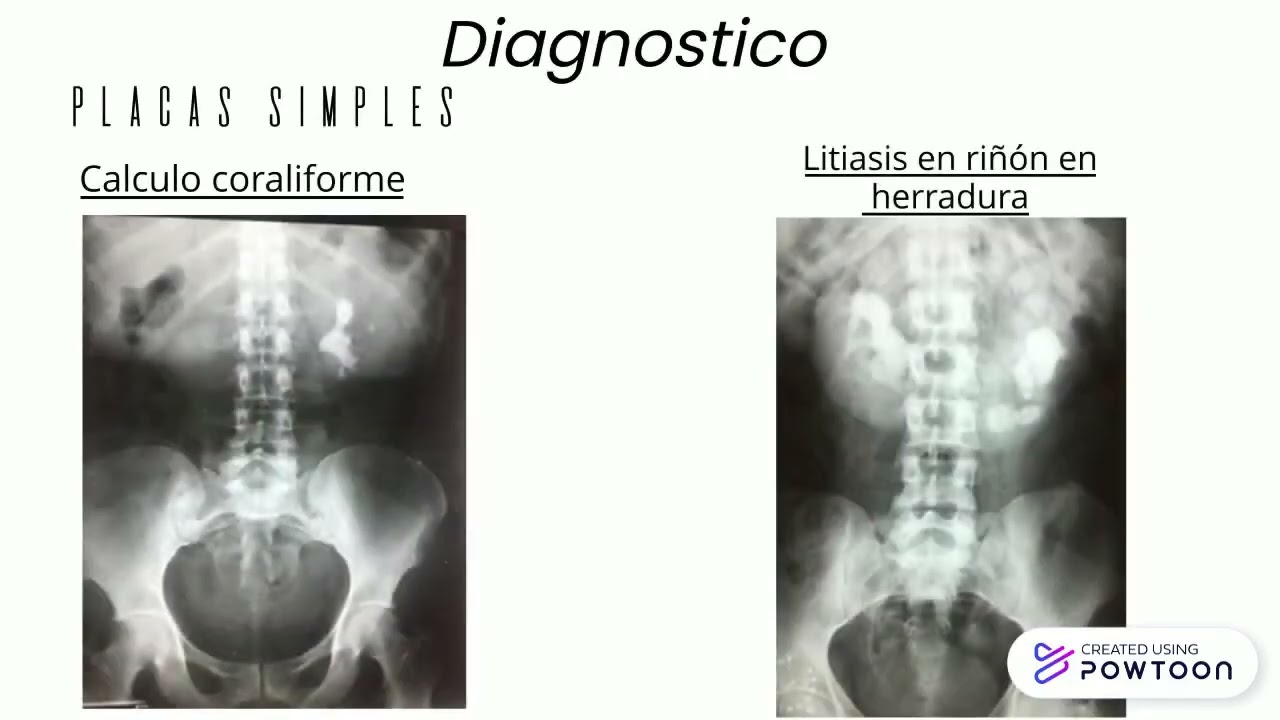 UROPATIA OBSTRUCTIVA