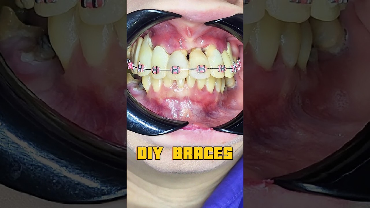 DIY Braces (Part 1)