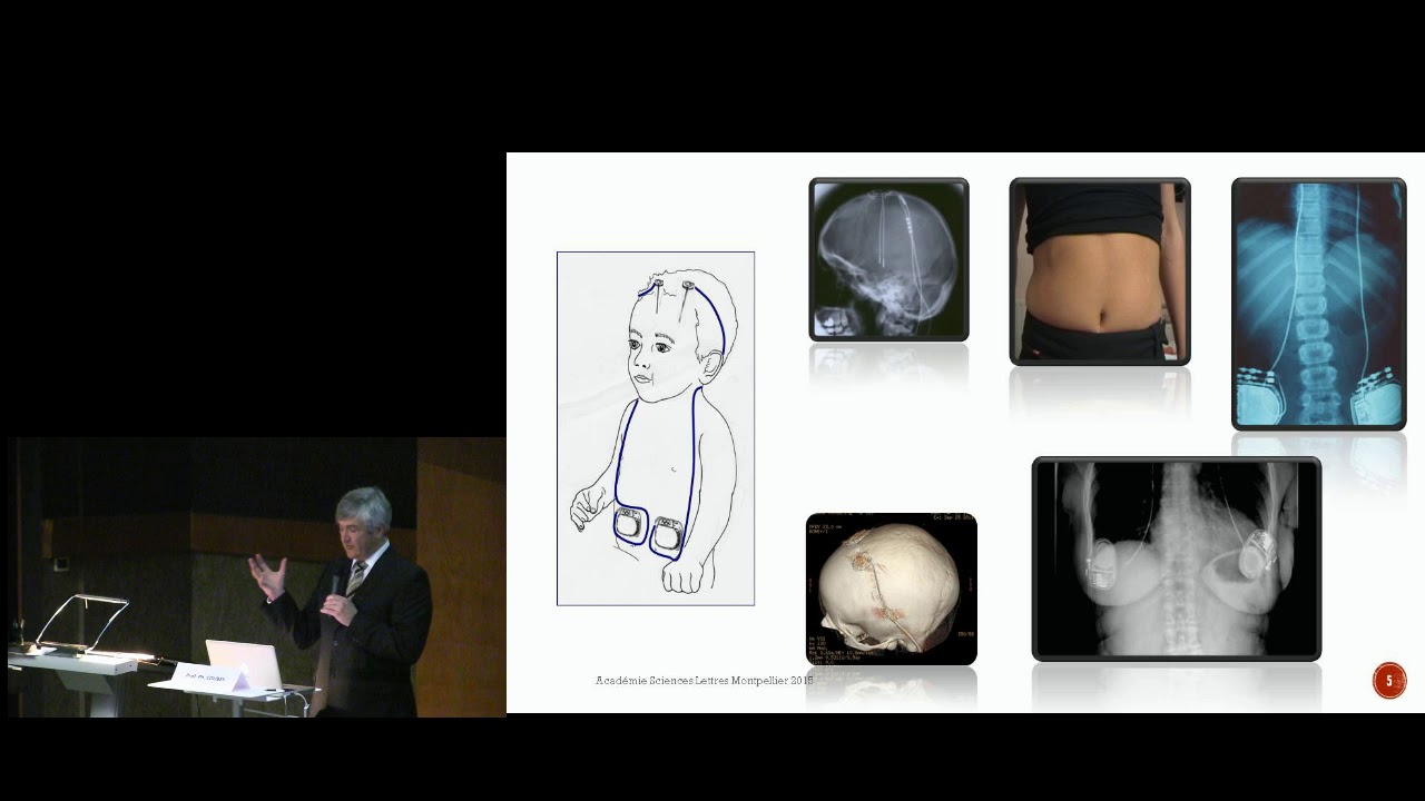 Agir sur la fonction cérébrale. Neuromodulation électrique.