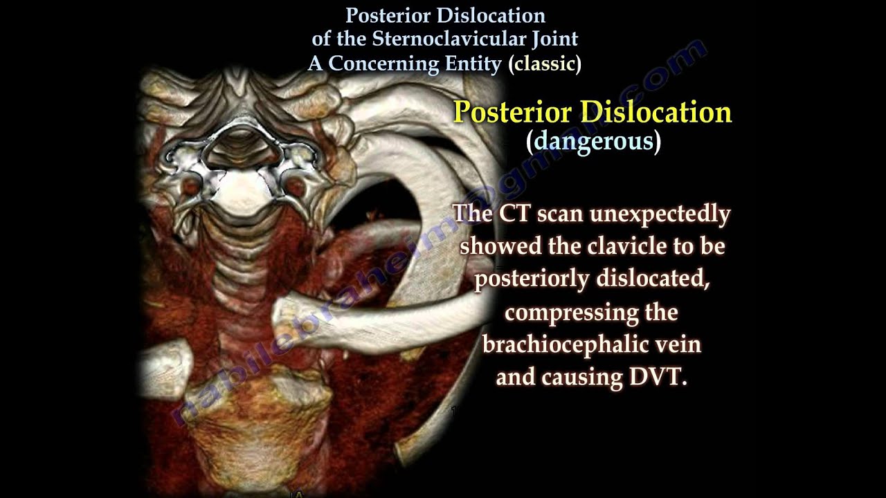 Posterior Dislocation Sternoclavicular Classic-Everything You Need To Know - Dr. Nabil Ebraheim