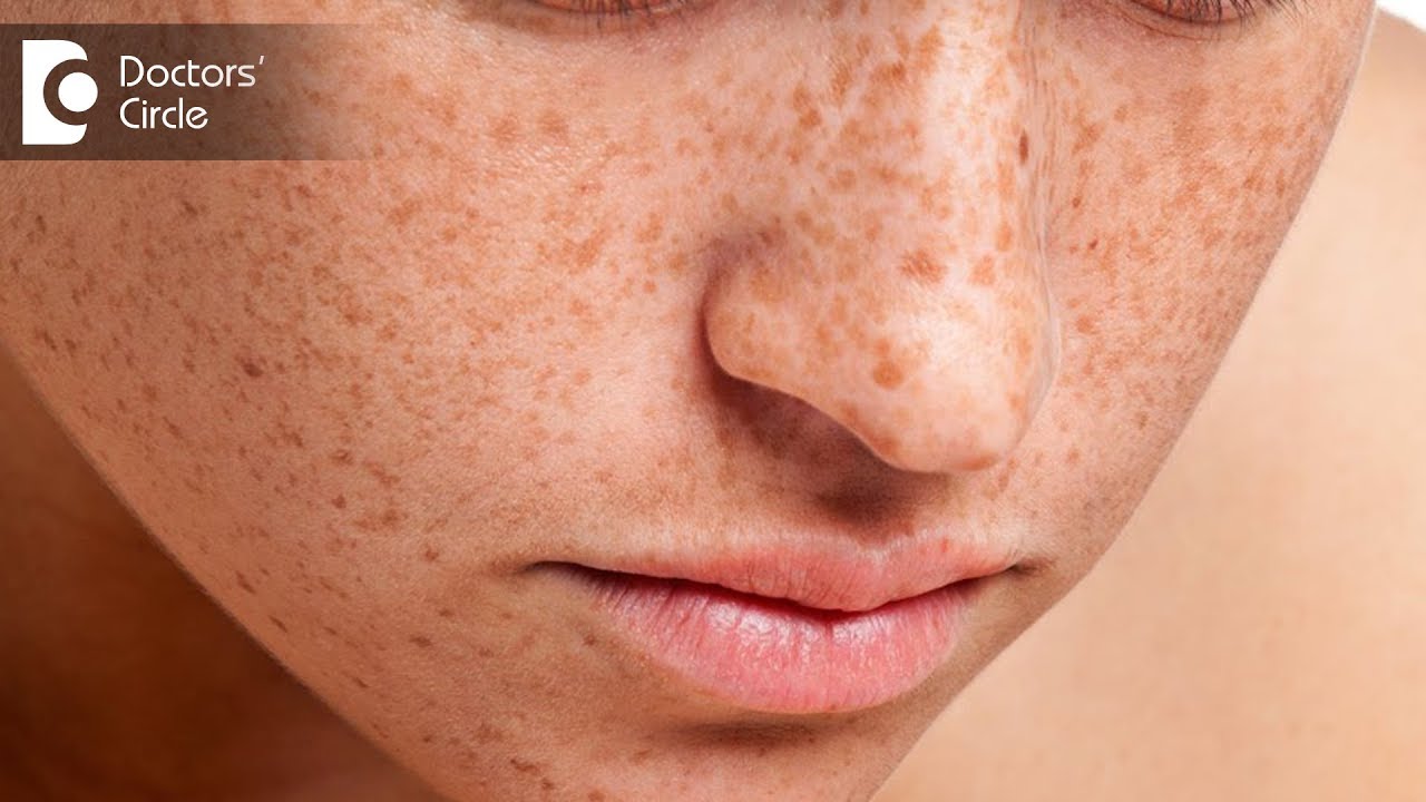 How to get rid of freckles on face? - Dr. Swetha Sunny Paul