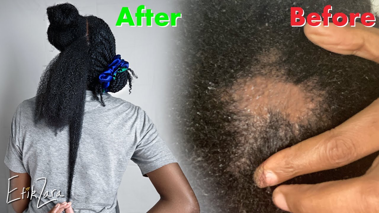 DETOX/UNCLOG SCALP + FOLLICLES for EXTREME GROWTH + VOLUME (Natural Hair) #ScalpCare | EfikZara