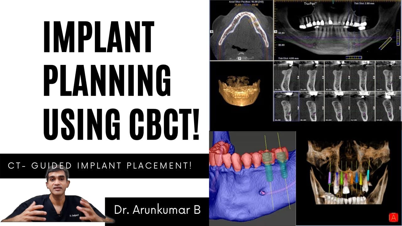 Dental Implant Planning with CBCT | Dr Arunkumar Pearls Dentistry | Dental Implants India Dentist
