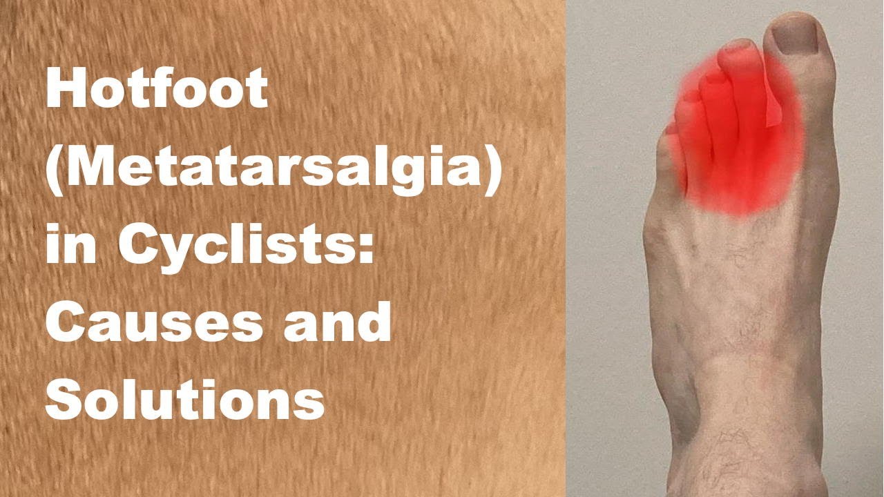 Hotfoot: Metatarsalgia in Cyclists