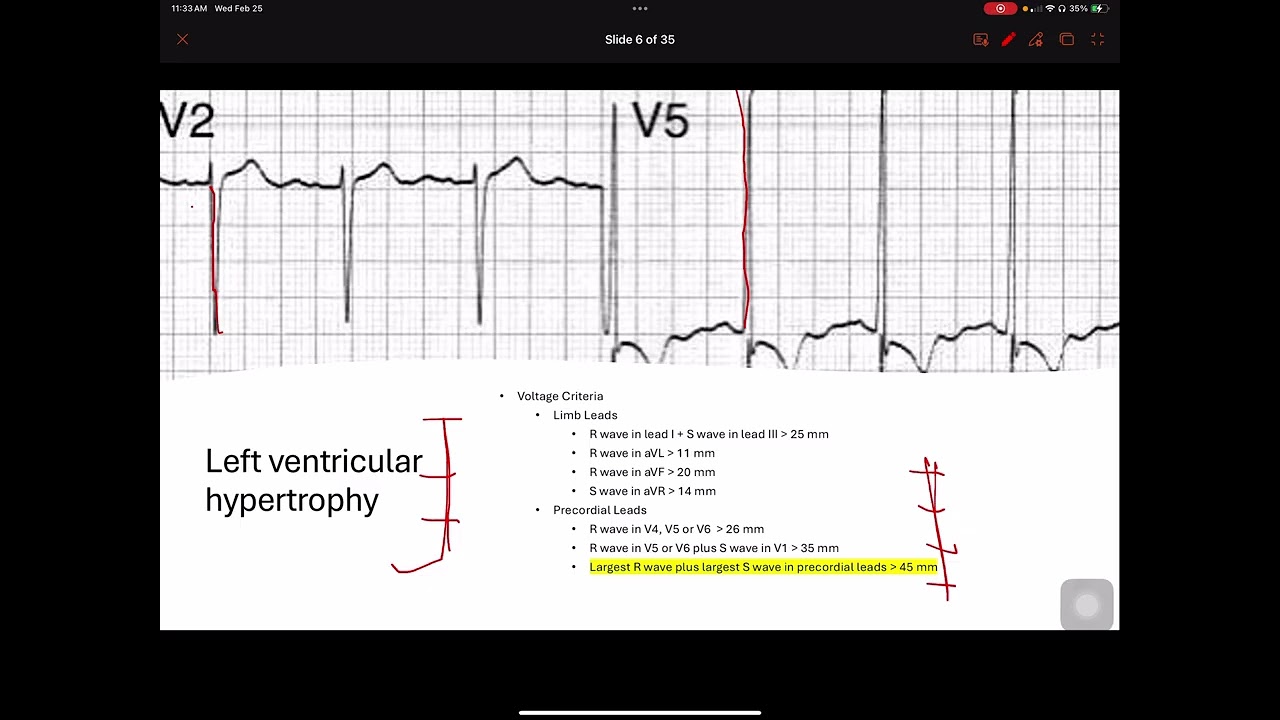 Intro to advanced 12 lead lecture 1