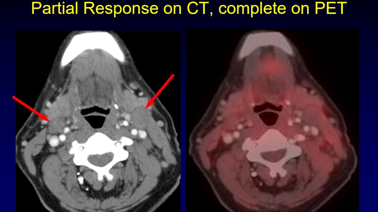Surveillance Imaging for Head and Neck Cancer:  The Rise of NIRADS