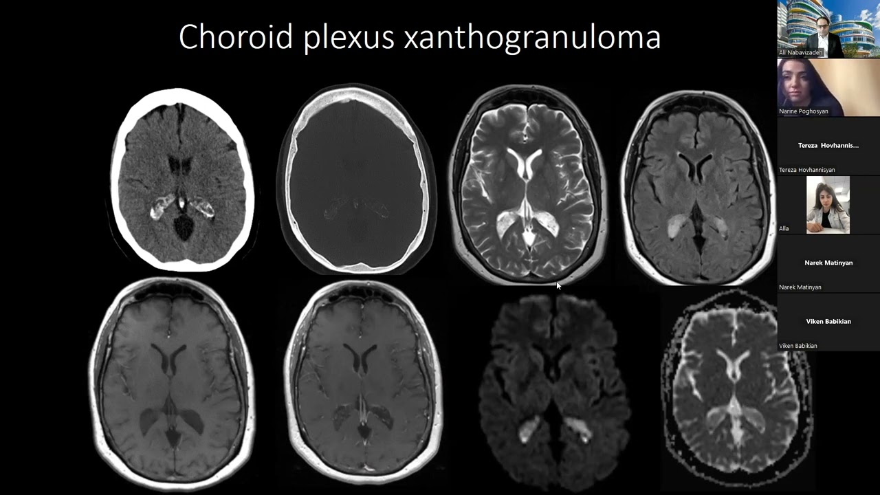 Dr Nabavizadeh presents Normal Variants-Don't Touch Lesions of the Brain   HD 1080p