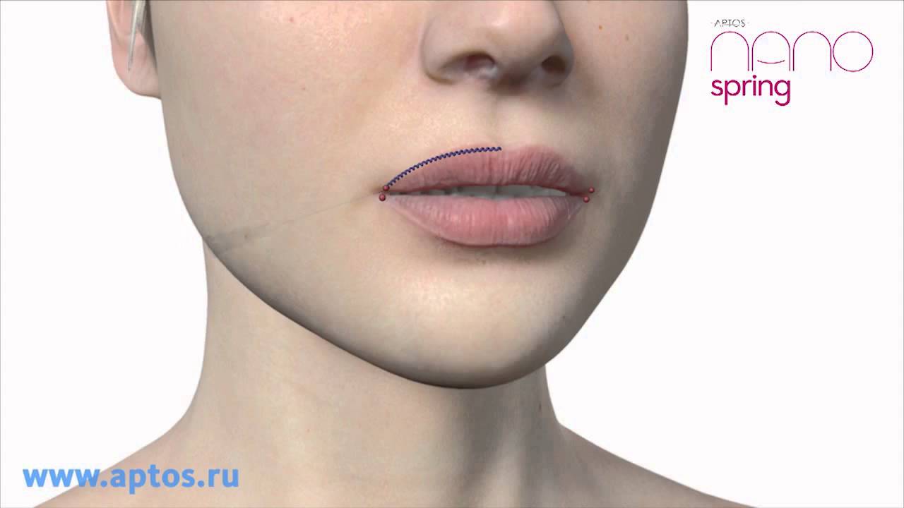 Lifting facial cu fire de suspensie