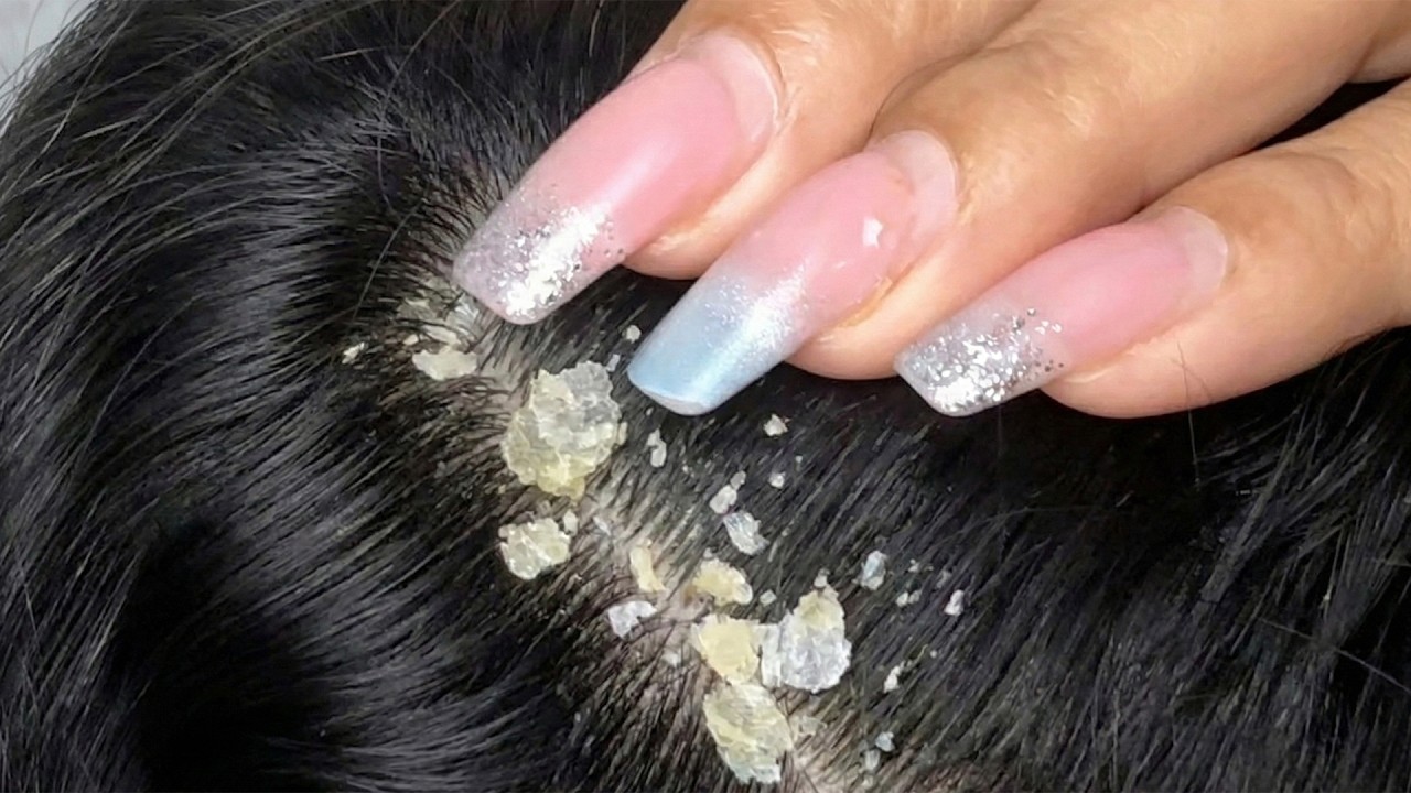 ASMR Satisfying Dandruff Treatment & Scalp Check #0019