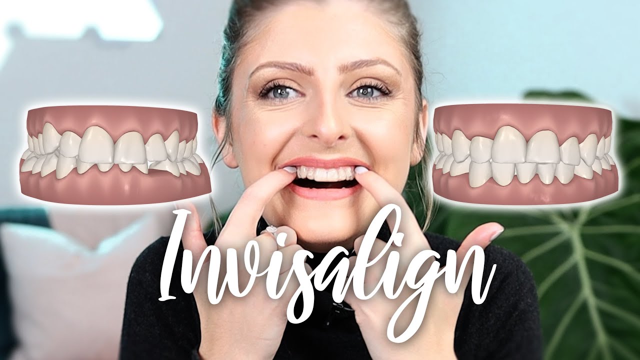 Я СДЕЛАЛА INVISALIGN! | ПОДРОБНЕЕ: всё о моих зубах + Недельный обзор + СОВЕТЫ!