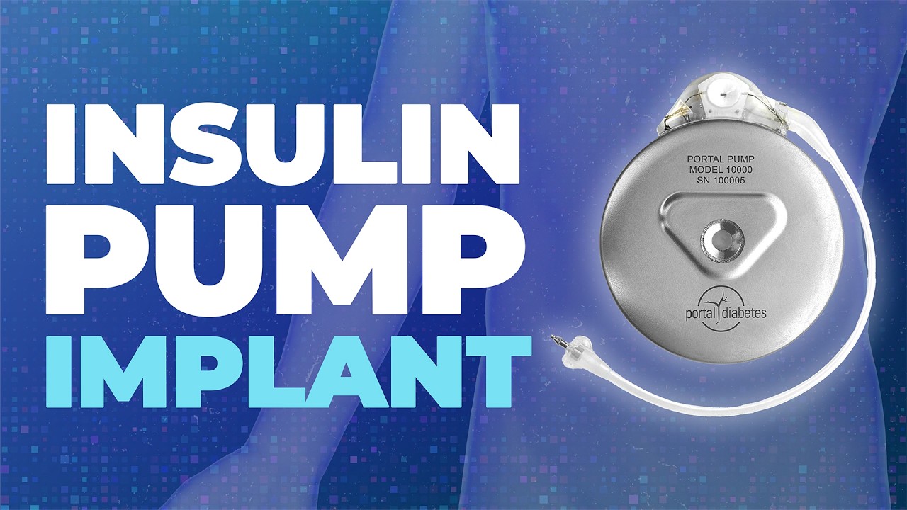 Inside an Implantable Artificial Pancreas in Development