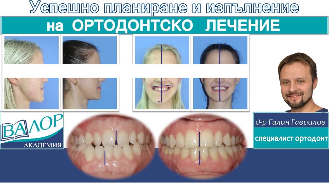 Ортодонтско-хирургично лечение на трети скелетен клас и латерогнатия. #ортодонтия #ортодонт #брекети