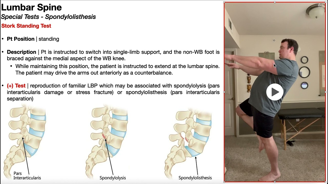 Stork Standing Test (for Spondylolisthesis) | Rationale & Interpretation