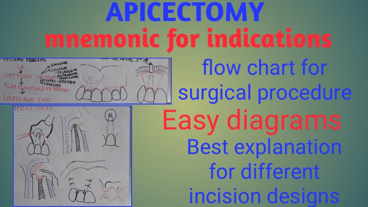 Apicectomy