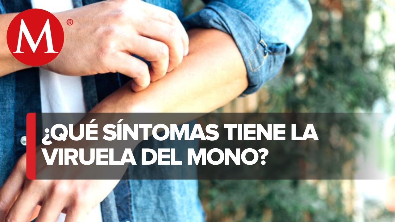Detectan segundo caso de viruela del mono en M&eacute;xico