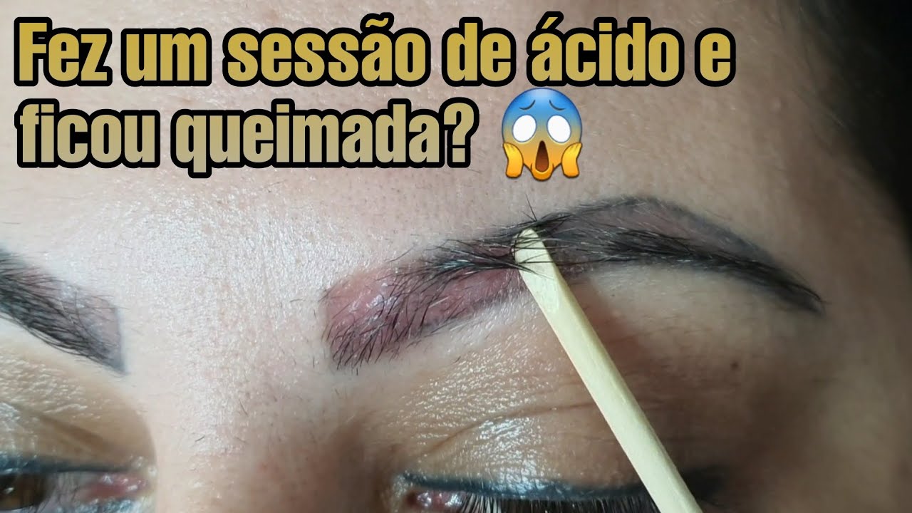 Remoção de micropigmentação. A cliente fez ácido e ficou com a sobrancelha queimada!!!