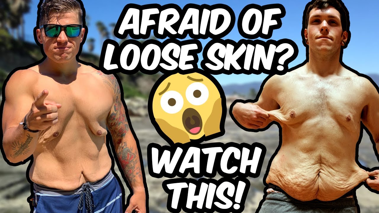 EVERYTHING you need to know about LOOSE SKIN after WEIGHT LOSS