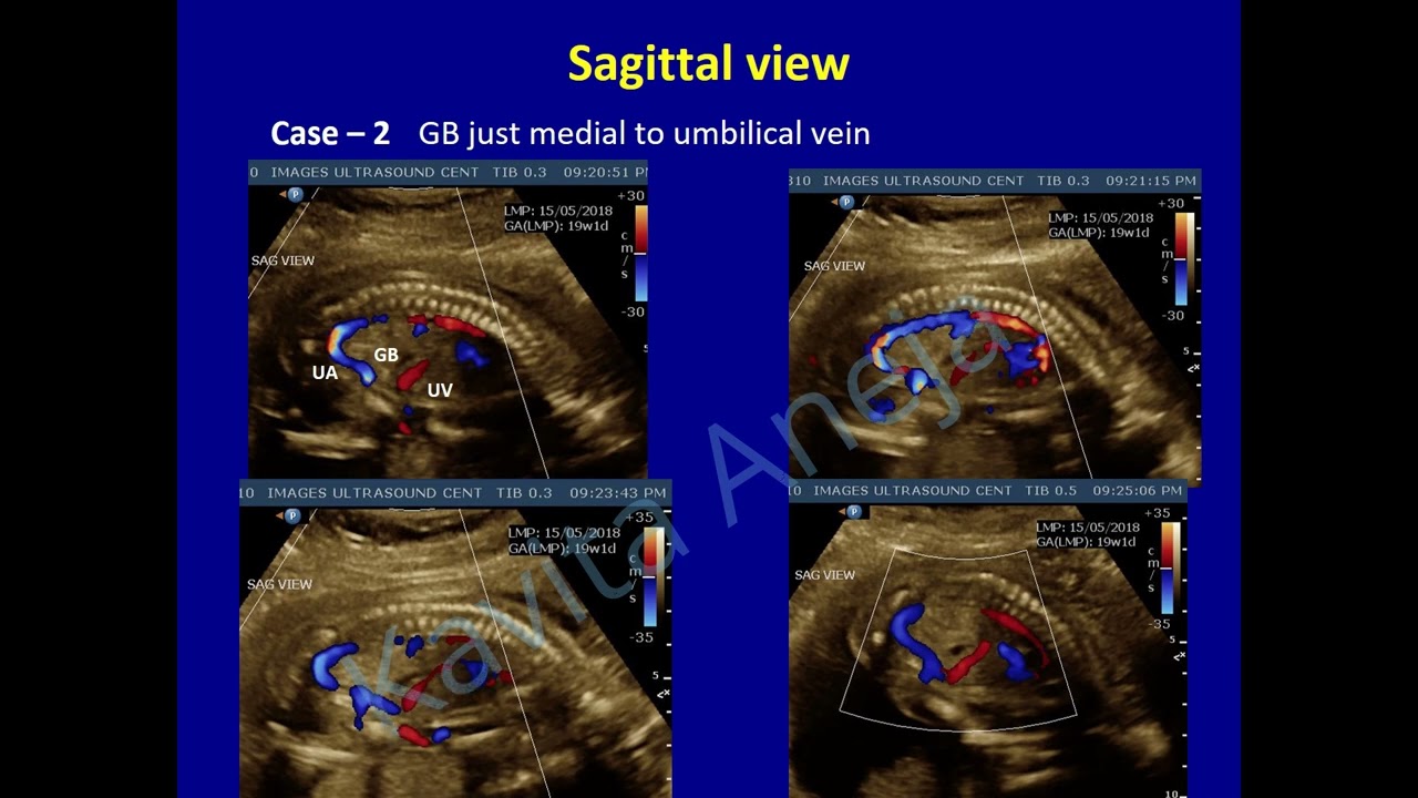 Umbilical - portal venous system and Persistent right umbilical vein