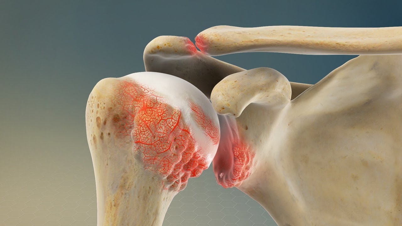 Googled Questions Shoulder Arthritis