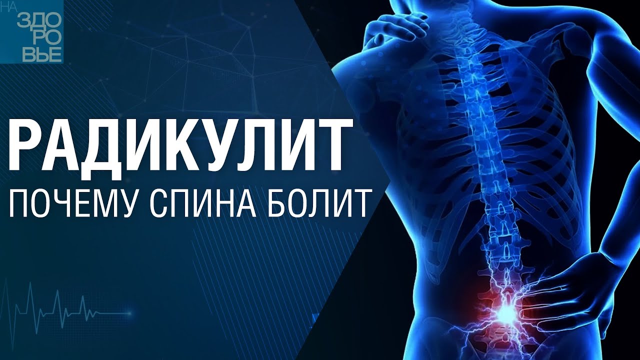 Радикулит. Почему спина болит. На здоровье 05.11.2022