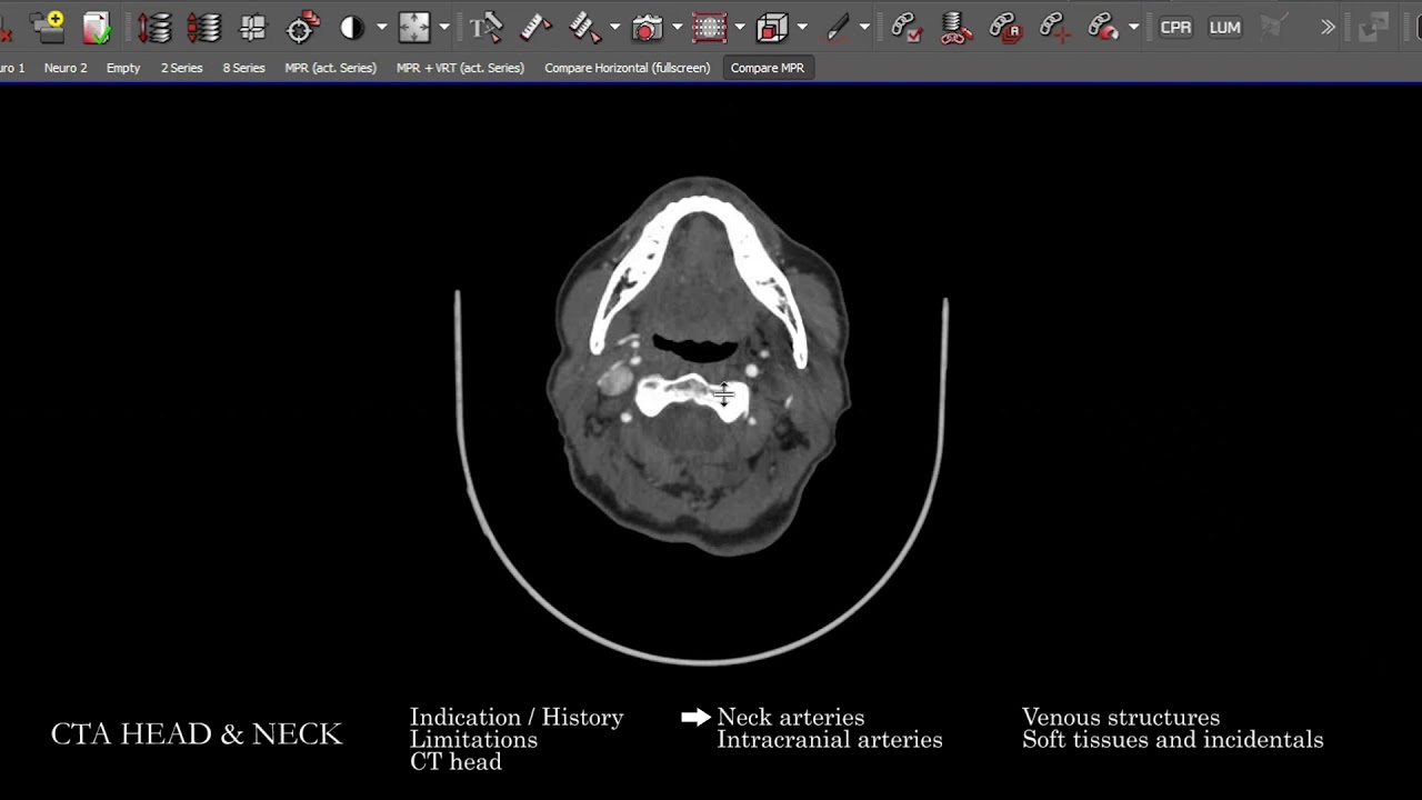 [CT] CTA Head and Neck | Search Pattern