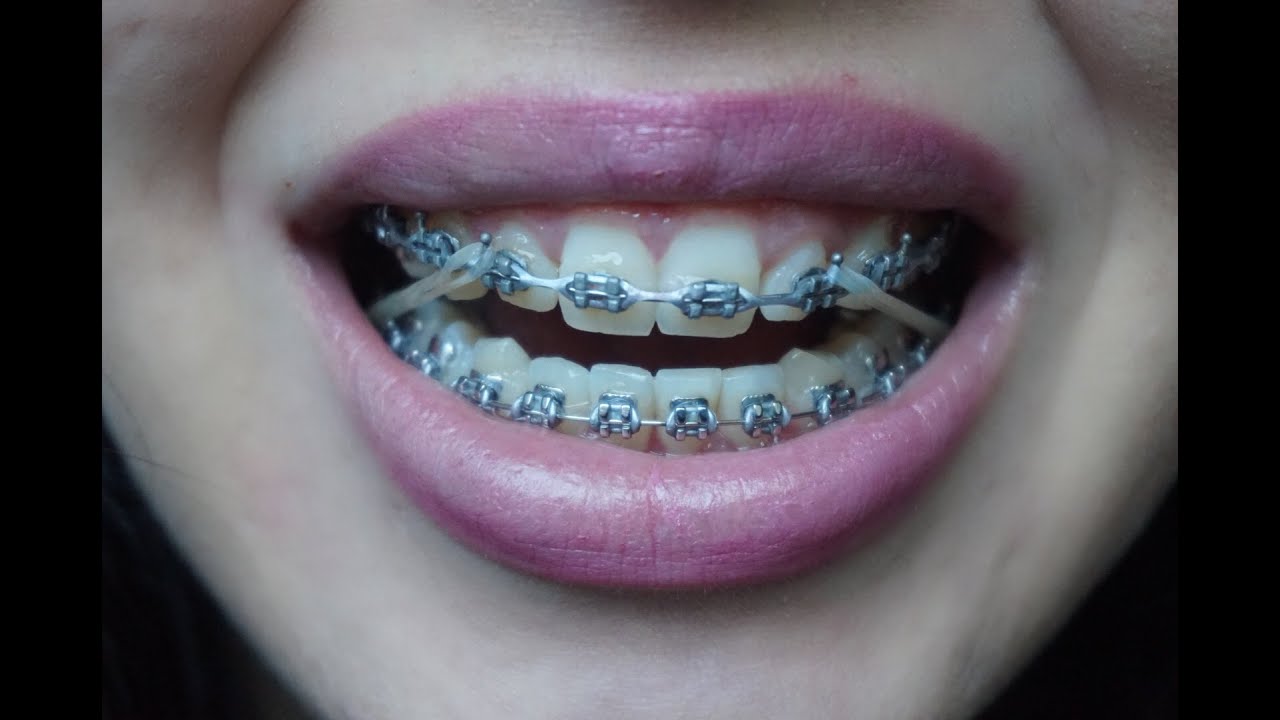 Braces/Ortho update: Close-up, elastics gone wrong, and more..