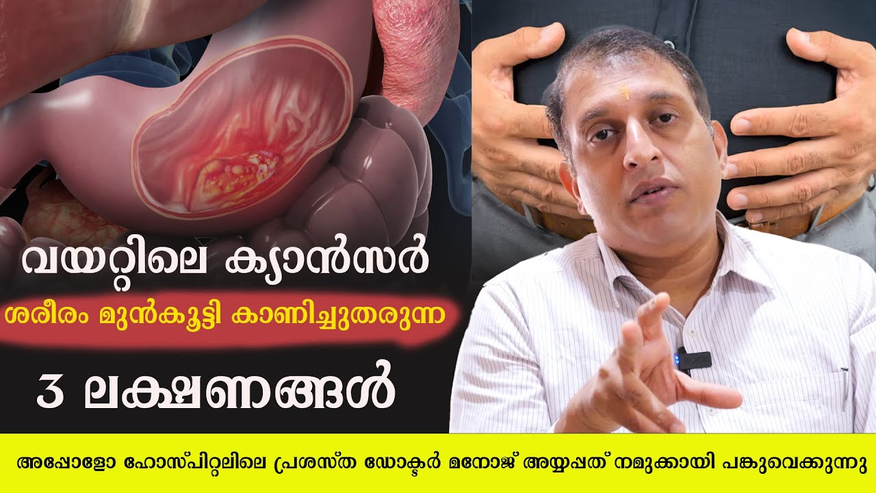 വയറ്റിലെ ക്യാൻസർ ശരീരം മുൻകൂട്ടി കാണിച്ചുതരുന്ന 3 ലക്ഷണങ്ങൾ/ Dr Manoj Ayyappath