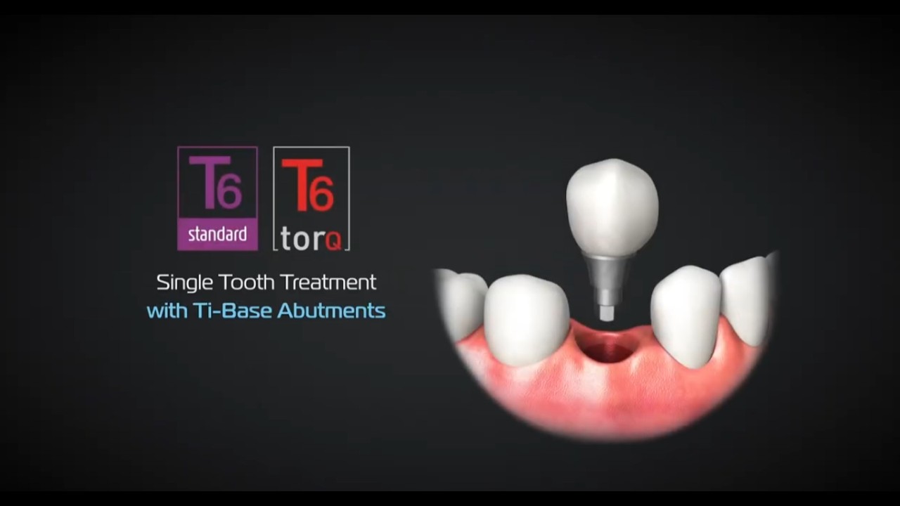 NucleOSS Ti-Base Abutments | Single Tooth Treatment
