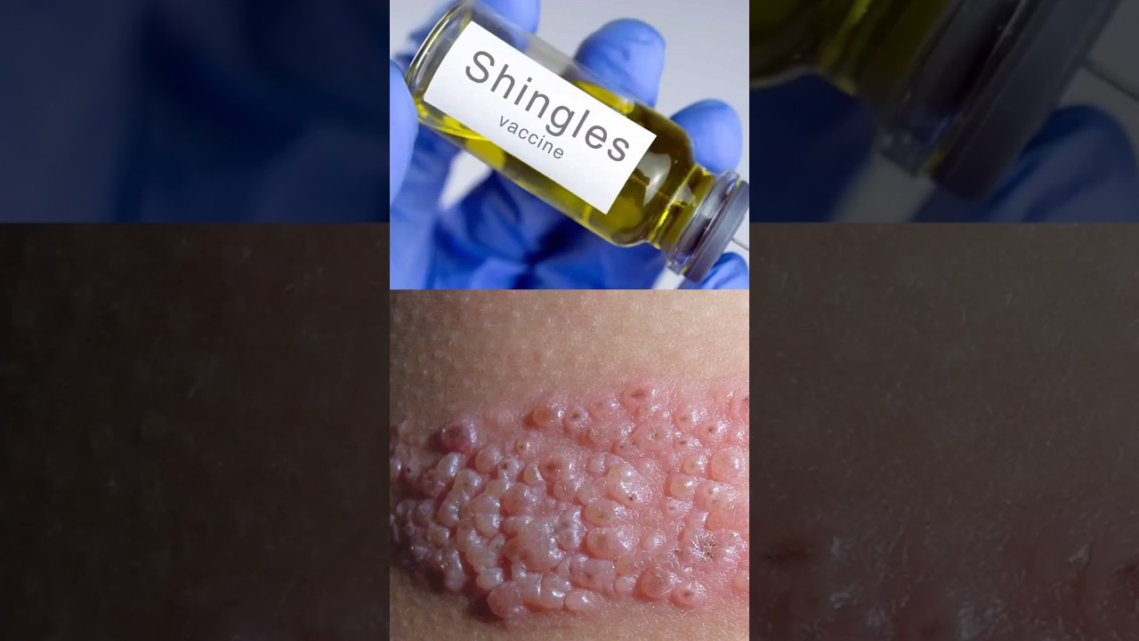 How Chicken Pox Leads to Shingles (Herpes Zoster) #chickenpox #shingles #vaccine #shorts #DMC