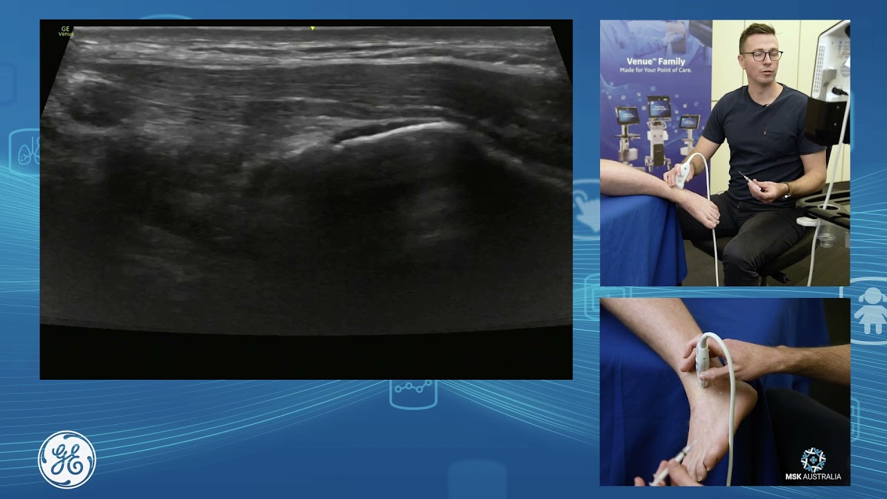 Ultrasound guided ankle and subtalar joint injection technique for POCUS clinicians