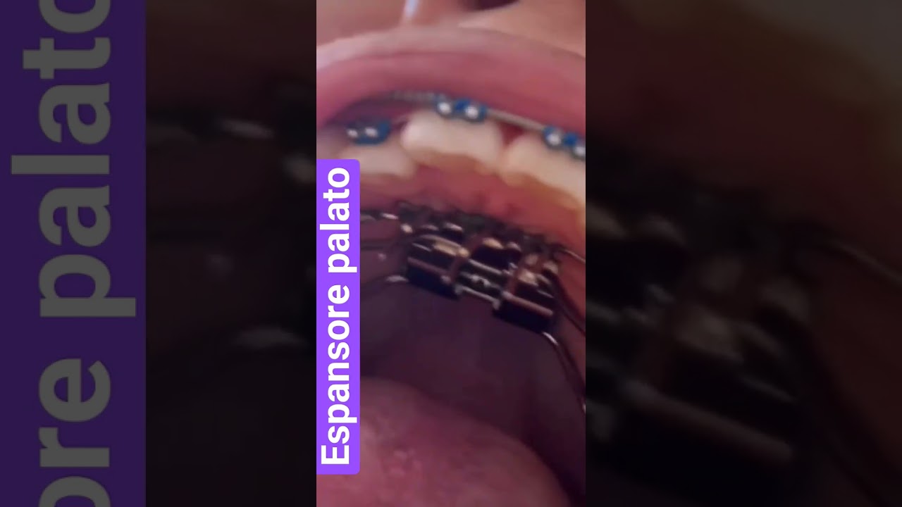 Espansore del palato
