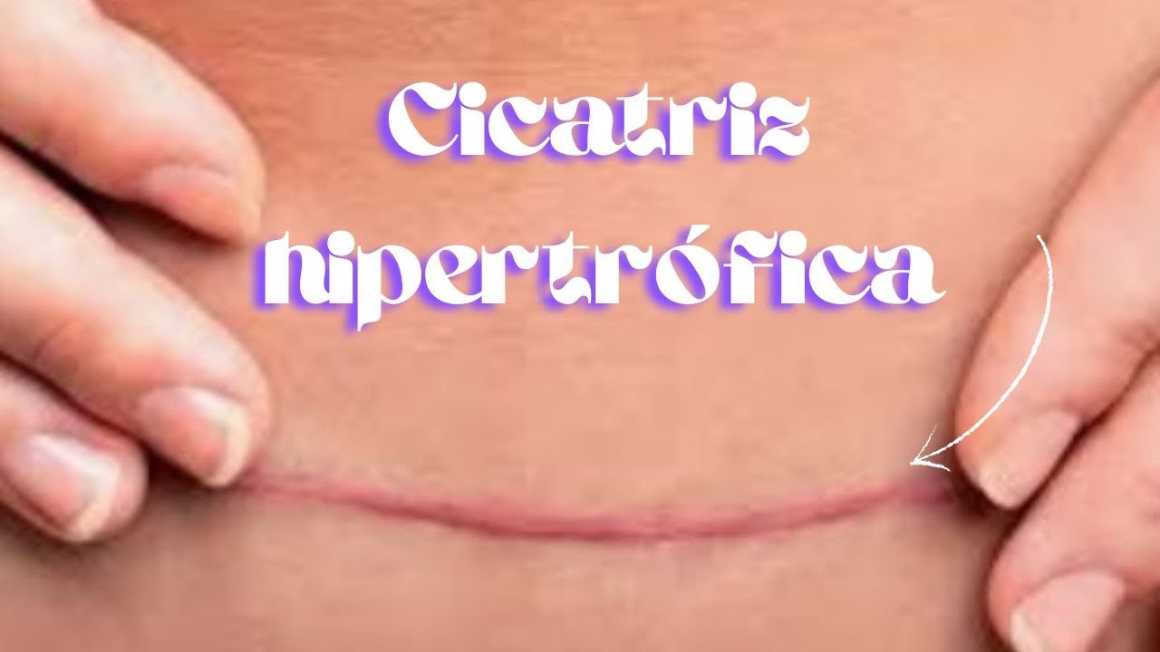 CICATRIZ Hipertrófica