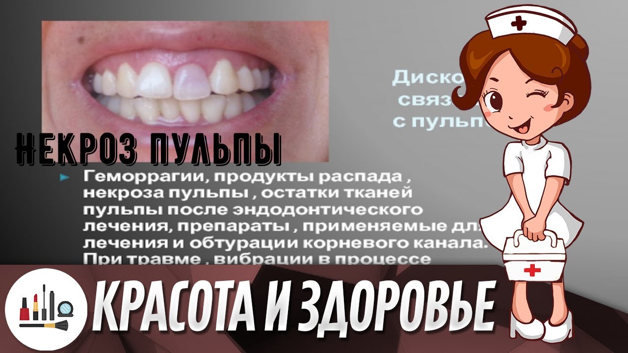 Некроз пульпы