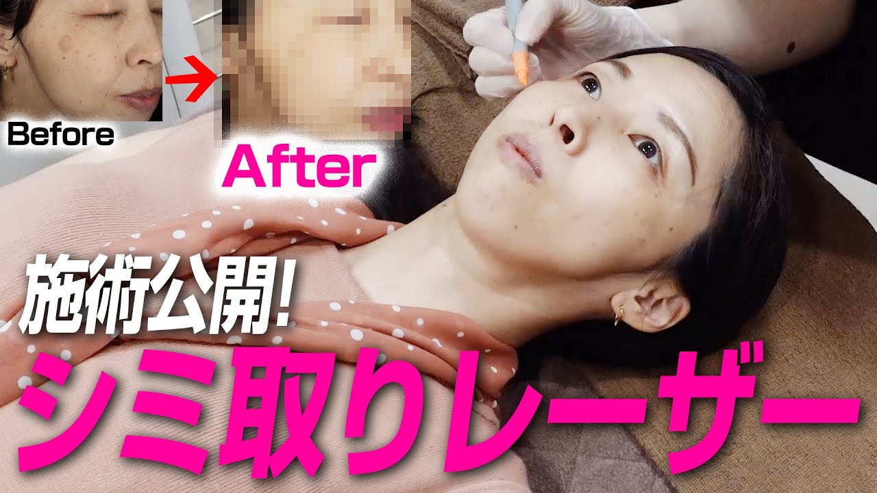 シミ取りレーザーを体験してもらいました。