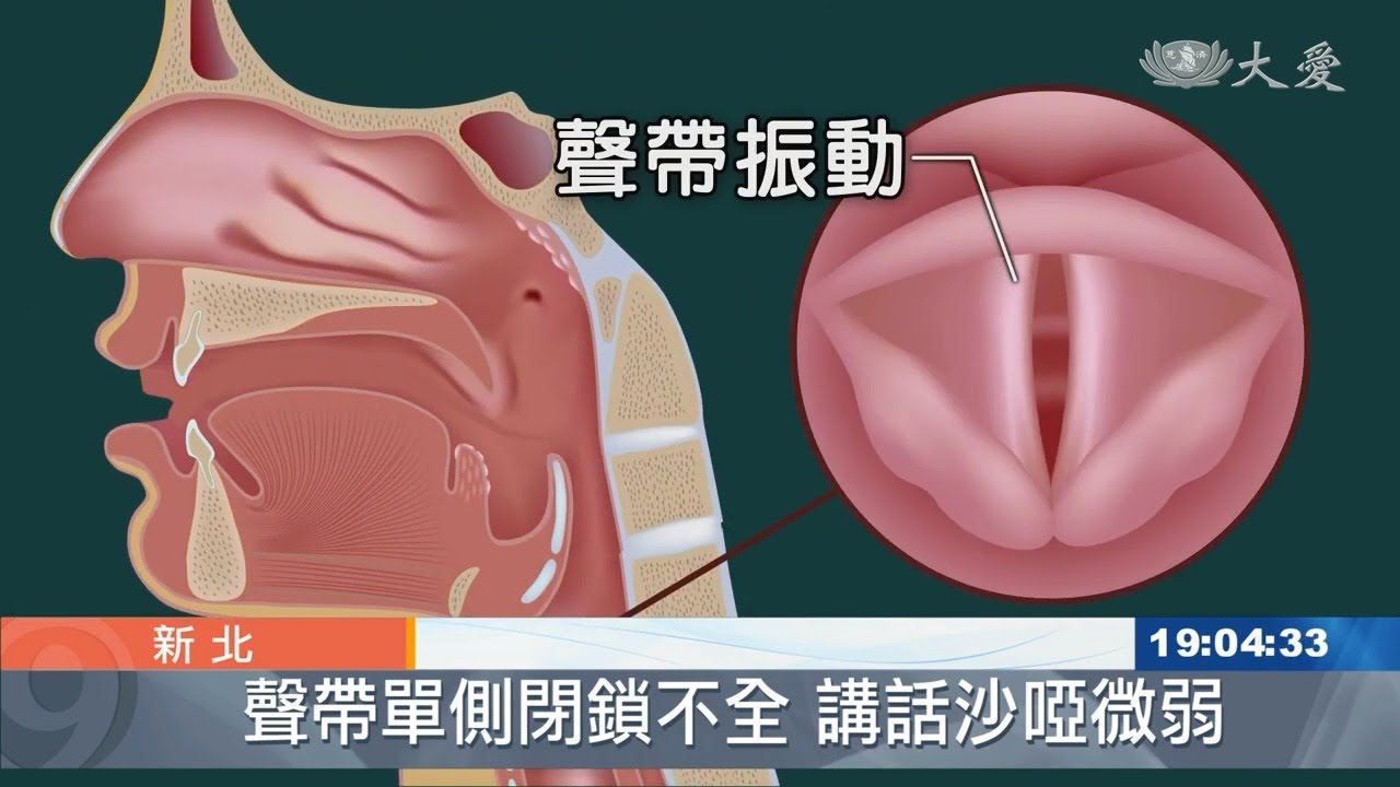 癌症術後聲帶麻痺無聲 玻尿酸注射改善