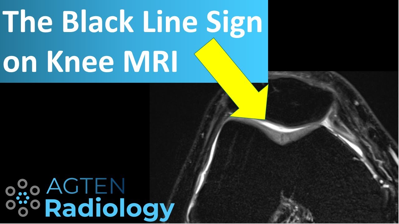 The Black Line Sign on Knee MRI