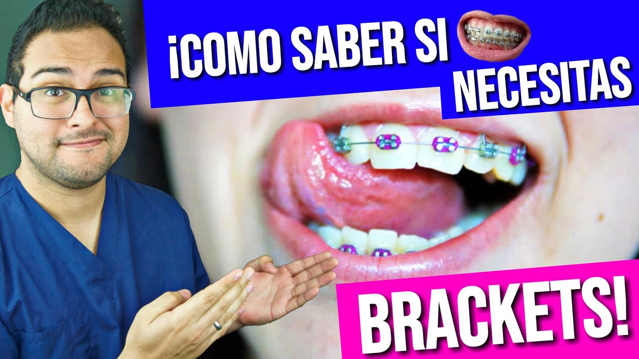 ¡COMO saber si necesito BRACKETS! 👅 GUÍA PRACTICA 2019 😎 #ORTODONCIA