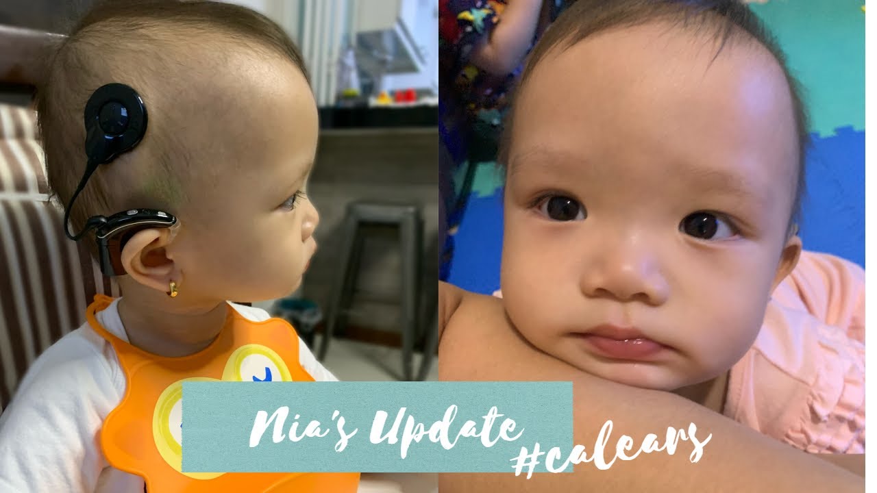 #CalEars : Nia's Update After Surgery and Switch On - Yellow Yum