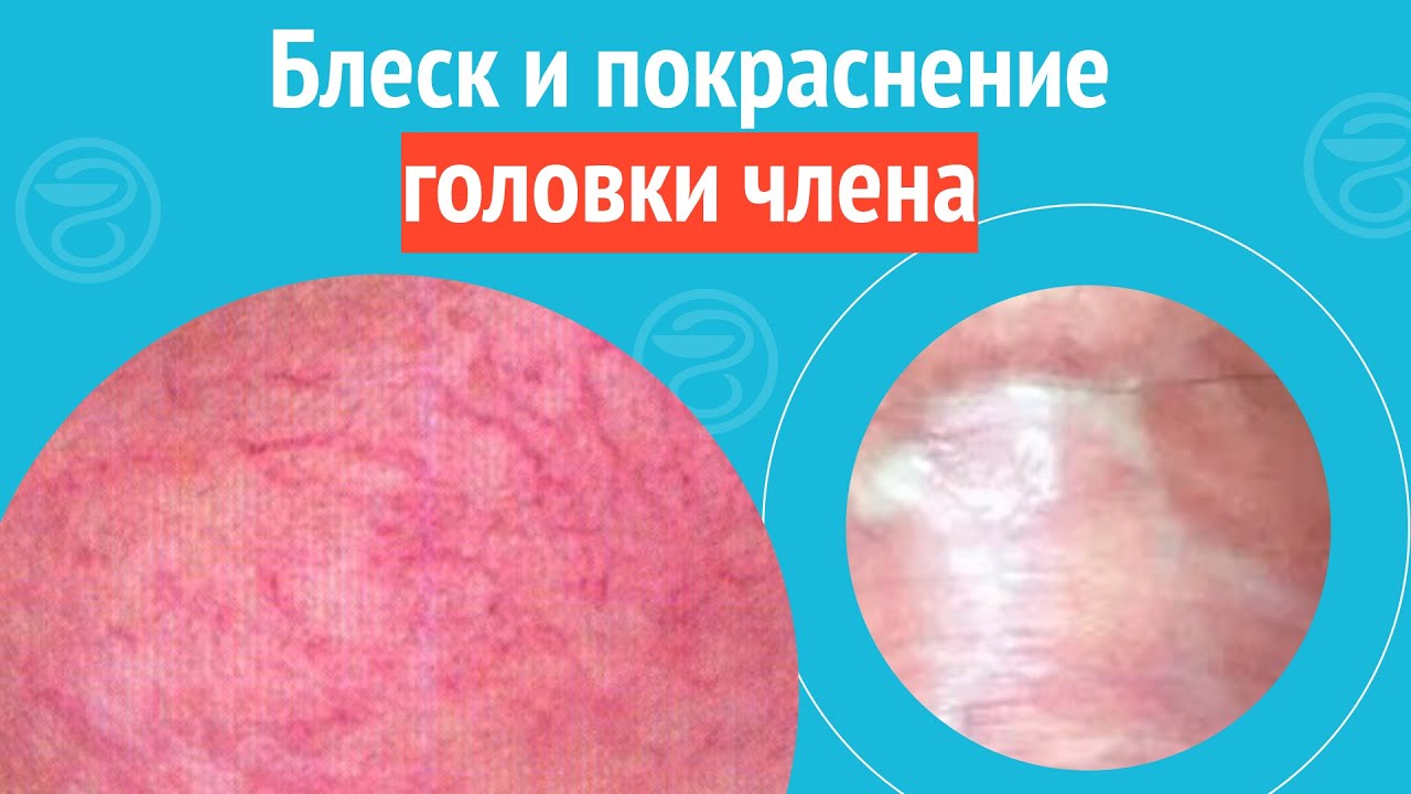🙄 Блеск и покраснение головки члена. Клинический случай №1195