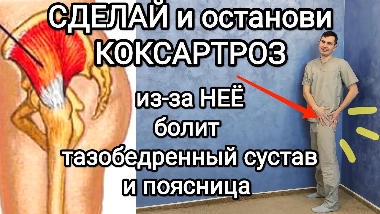 Останови КОКСАРТРОЗ / из-за этой мышцы болит тазобедренный сустав и поясница + перекос таза /Часть 1