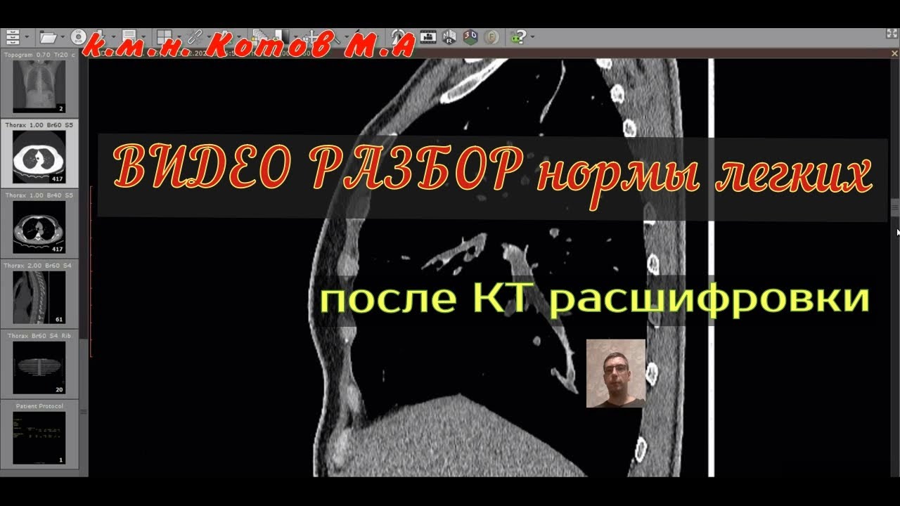 ВИДЕО РАЗБОР и оценка результатов КТ ЛЕГКИХ в норме после КТ РАСШИФРОВКИ