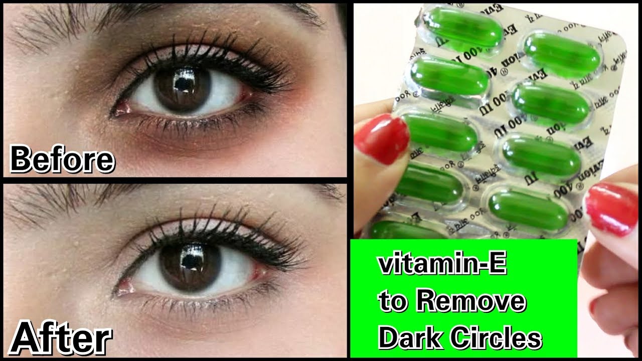 Remove Dark Circles in 3 days with Vitamin- E (100% Works)