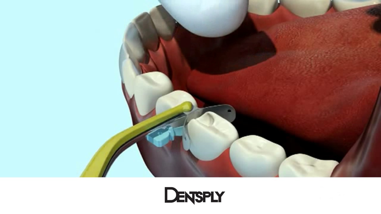 Sistema de Matrices Palodent V3 de Dentsply