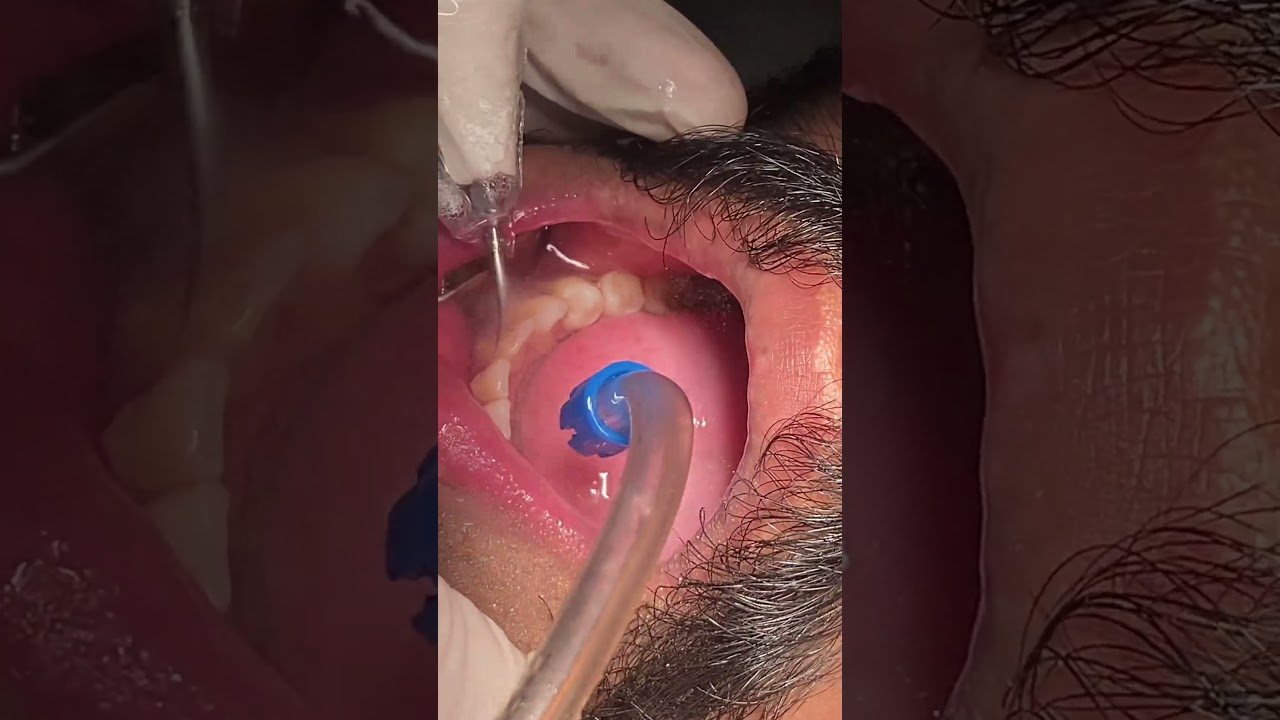 Scaling and polishing with  Floride therapy 