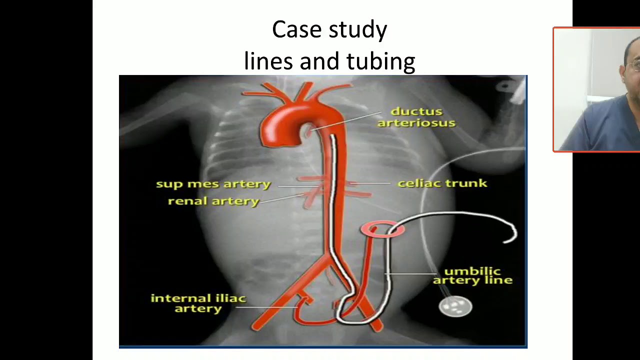 Case scenarios 3 what are  chest tube insertion indications and complications?