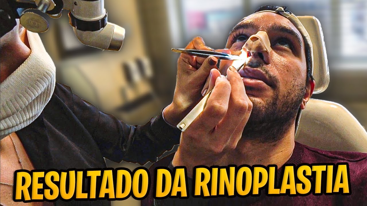 RETIREI O CURATIVO DO NARIZ - RESULTADO DA RINOPLASTIA!