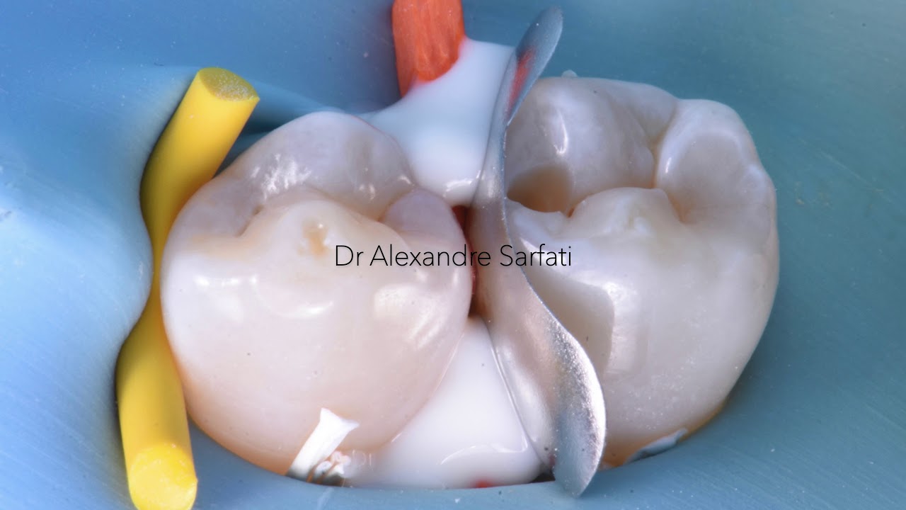 From IDS to Ceramic Bonding Procedure