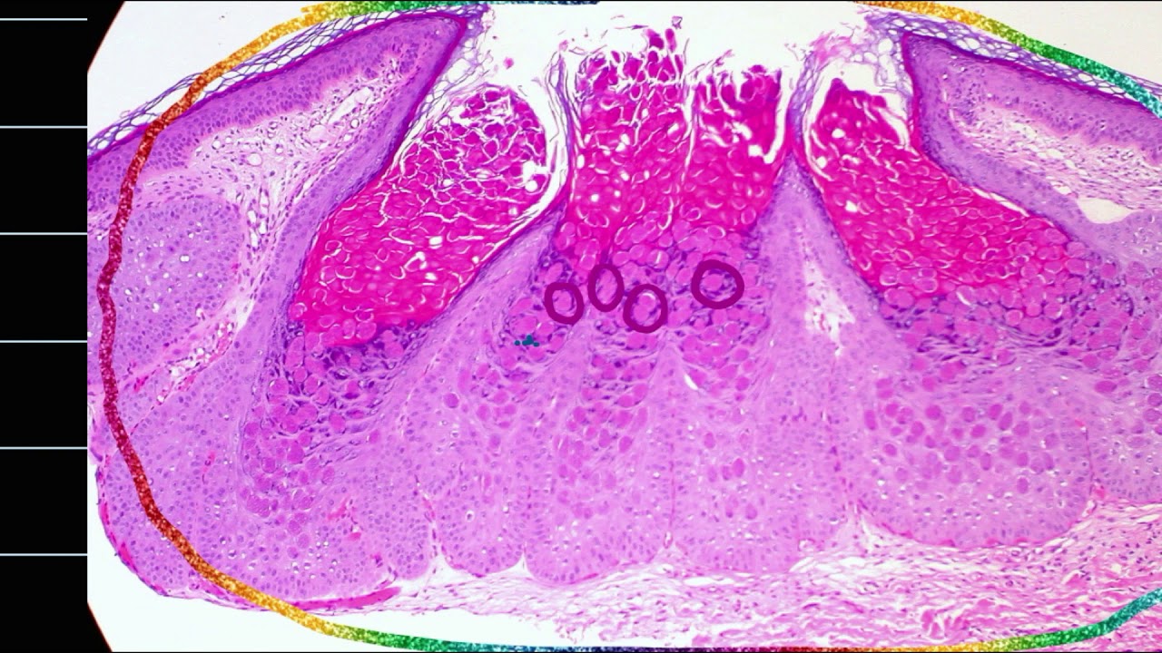 DERMA PATH SERIES- MOLLUSCUM CONTAGIOSUM