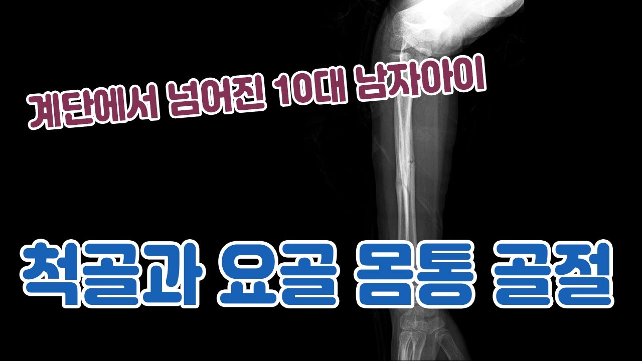 척골과 요골 몸통 골절(소아)